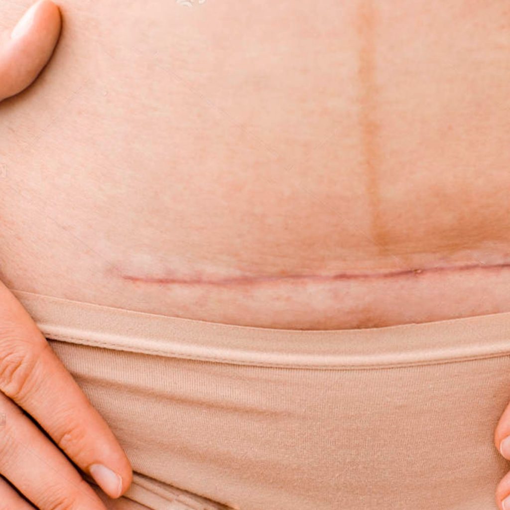 Cicatriz da cesárea: 3 problemas comuns e como resolver - Revista